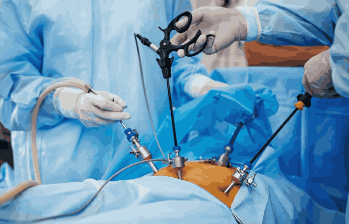 What Surgeries Use Laparoscopy
