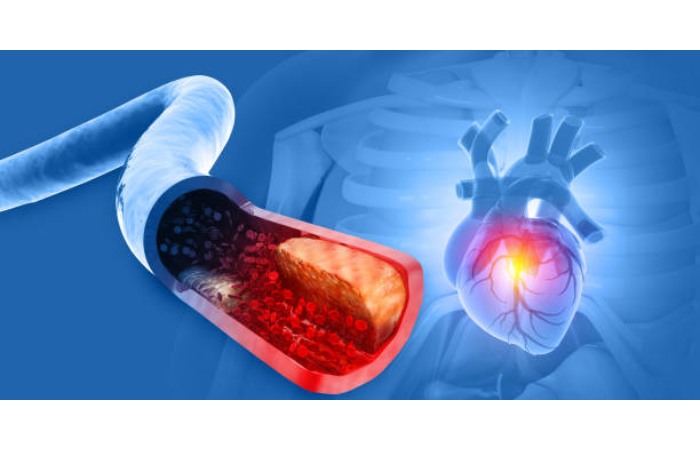 Where and When is Particle Pollution a Problem
